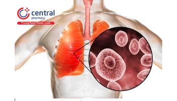 Các loại bệnh nấm phổi thường gặp và cách điều trị