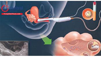 Các phác đồ kích thích buồng trứng trong điều trị vô sinh hiếm muộn