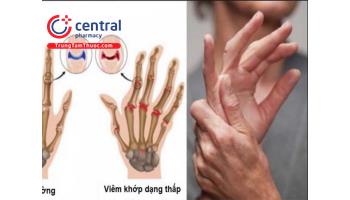 CÁC TIÊU CHUẨN CHẨN ĐOÁN ĐỢT TIẾN TRIỂN CỦA BỆNH VIÊM KHỚP DẠNG THẤP