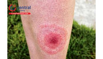 Cách nhận biết và điều trị sớm bệnh Lyme