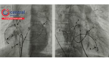 Can thiệp cuồng nhĩ điển hình trong chống rối loạn nhịp tim