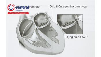 Can thiệp hở cạnh van nhân tạo - Một lựa chọn đầu tay