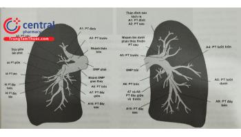 Can thiệp nong bóng trong điều trị tăng áp mạch máu phổi do thuyên tắc huyết khối mạn tính (CTEPH)