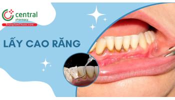 Cao răng (vôi răng) là gì? Tác dụng, tác hại của việc lấy cao răng