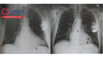 Cấy máy phá rung tự động - Một phương pháp hồi sinh tim phổi
