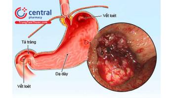 Chẩn đoán, nguyên nhân và điều trị xuất huyết tiêu hóa cao