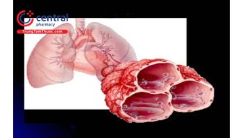 Chẩn đoán và điều trị phù phổi cấp huyết động do tim
