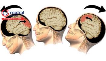 Chấn thương sọ não: nguyên nhân, triệu chứng, điều trị và phòng ngừa