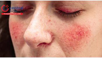 Chứng đỏ mặt (Rosacea): nguyên nhân và cách điều trị