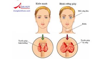 Cường giáp: nguyên nhân gây bệnh, cơ chế và triệu chứng
