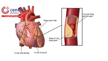 Đau thắt ngực không ổn định và nhồi máu cơ tim không có ST chênh lên 