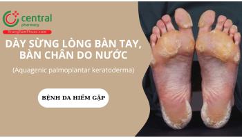 Dày sừng lòng bàn tay, bàn chân do nước (Aquagenic palmoplantar keratoderma): biểu hiện, cách điều trị
