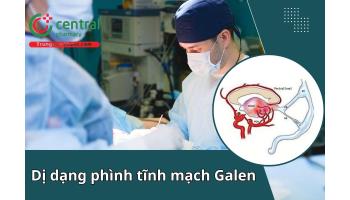 Dị dạng phình tĩnh mạch Galen (VGAM): Tổng quan cập nhật