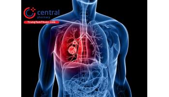 Điều trị ung thư phổi nguyên phát bằng hóa chất 