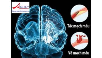 Đột quỵ não là gì? Các yếu tố nguy cơ gây đột quỵ