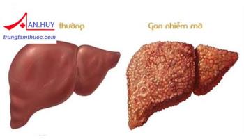 Nhận thức chung về gan nhiễm mỡ và những nguyên nhân gây bệnh