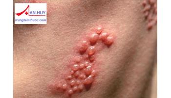 Herpes sinh dục: nguyên nhân, chẩn đoán và cách điều trị