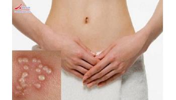 Herpes sinh dục: Triệu chứng, chẩn đoán và điều trị