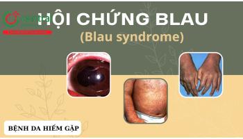 Hội chứng Blau (Blau syndrome): biểu hiện lâm sàng, chẩn đoán và điều trị