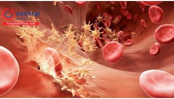 Hội chứng đông máu rải rác trong lòng mạch (DIC): triệu chứng, điều trị