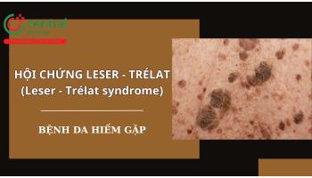 Hội chứng Leser - Trélat (Leser - Trélat syndrome): dày sừng da đầu kết hợp với ung thư nội tạng