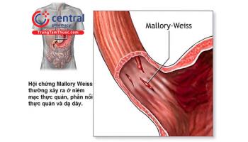 Hội chứng Mallory-Weiss: định nghĩa, nguyên nhân, hướng dẫn điều trị