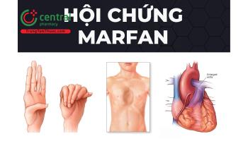 Hội chứng Marfan là đột biến gì? Nguyên nhân, triệu chứng và cách điều trị