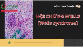 Hội chứng Wells (Wells syndrome) - Viêm mô bào tăng bạch cầu ái toan