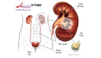 ĐIỀU TRỊ NỘI KHOA BỆNH SỎI THẬN TIẾT NIỆU
