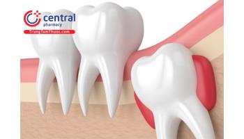 Khi nào nên nhổ răng khôn (răng số 8) bị mọc lệch? Nhổ răng khôn có đau không?