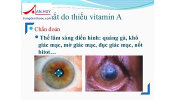 Bệnh khô mắt do thiếu vitamin A: triệu chứng và cách điều trị