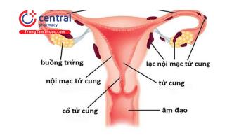 Lạc nội mạc tử cung: nguyên nhân, triệu chứng và cách điều trị