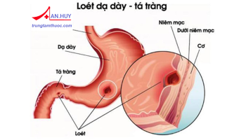 Loét dạ dày tá tràng: nguyên nhân, triệu chứng, điều trị bệnh
