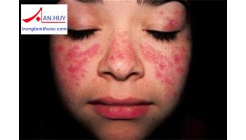 Bệnh lupus ban đỏ hệ thống: những điều cần biết