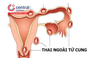 Mang thai ngoài tử cung: nguyên nhân, triệu chứng và cách điều trị