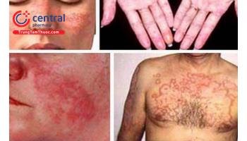 Nguyên nhân, chẩn đoán và điều trị bệnh lupus ban đỏ hệ thống 