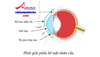 Tân sản vảy bề mặt nhãn cầu: nguyên nhân, triệu chứng và điều trị
