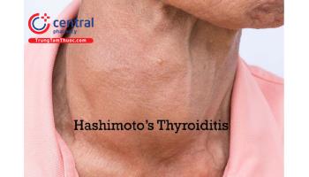 Nguyên nhân, triệu chứng, điều trị viêm tuyến giáp Hashimoto