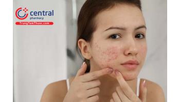 Nguyên nhân và cách điều trị mụn trứng cá hiệu quả