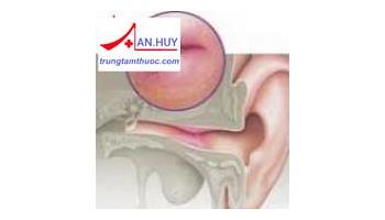 NHỌT ỐNG TAI: TRIỆU CHỨNG, NGUYÊN NHÂN VÀ ĐIỀU TRỊ