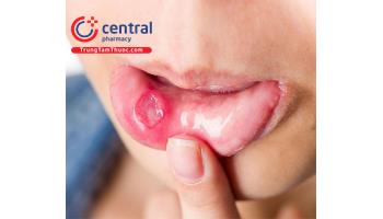 Nhiệt miệng: triệu chứng, cách điều trị và phòng ngừa