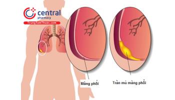 Những thông tin cần biết và bệnh tràn mủ màng phổi