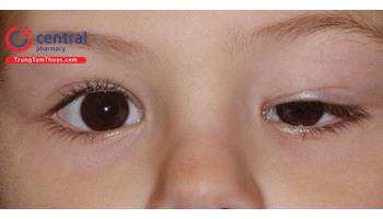 Đánh giá tình trạng lâm sàng của các dạng sụp mí mắt 