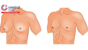 Đánh giá bệnh vú to nam giới là sinh lý hay bệnh lý