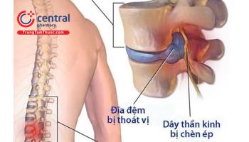 Phương pháp vật lý trị liệu trong điều trị thoát vị đĩa đệm