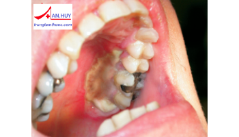 Răng sữa bị hoại tử tủy: chẩn đoán và điều trị bệnh