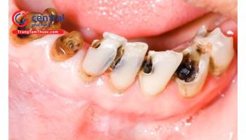 Sâu răng: nguyên nhân, triệu chứng và điều trị   