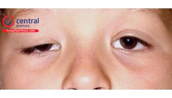 Sụp mi mắt: nguyên nhân, phân loại và điều trị sụp mi