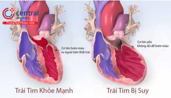 Suy tim mạn tính: nguyên nhân, chẩn đoán và phác đồ điều trị