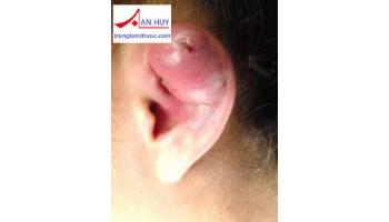 TỤ MÁU VÀNH TAI tin tức tại bệnh tai mũi họng